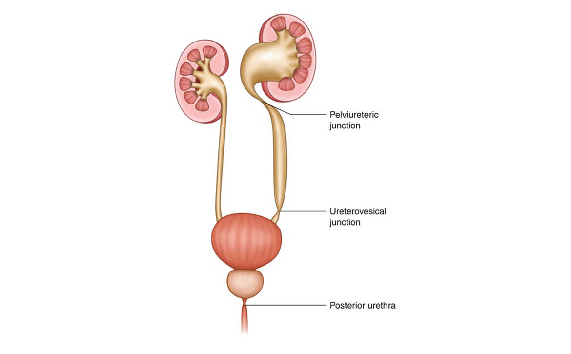 Vesico Ureteric Junction obstruction (VUJO), Robotic Surgery in India, Robotic Surgery Hospitals in India
